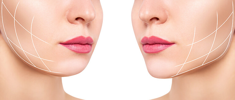 頬の脂肪吸引とは
