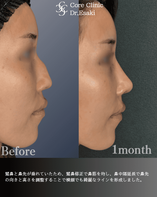 鼻中隔延長の症例：横顔の術前後（Before/After）比較｜コアクリニック