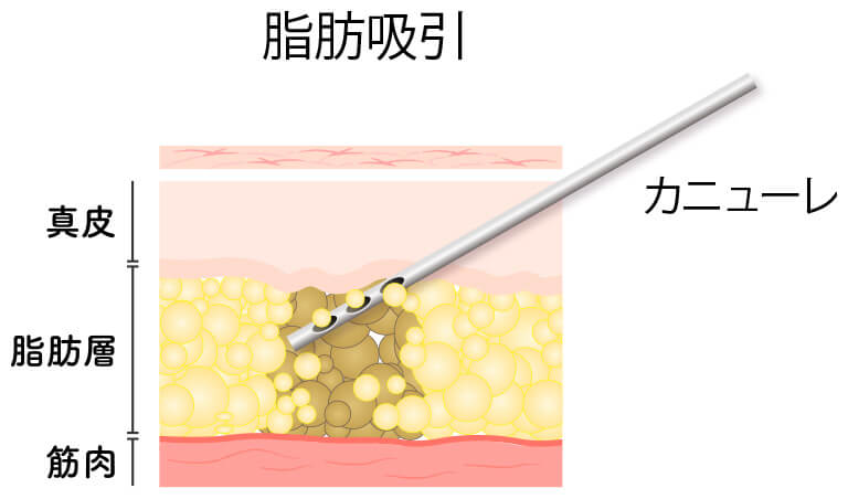 脂肪吸引