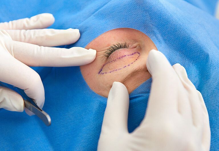 失敗しない眼瞼下垂術のポイント