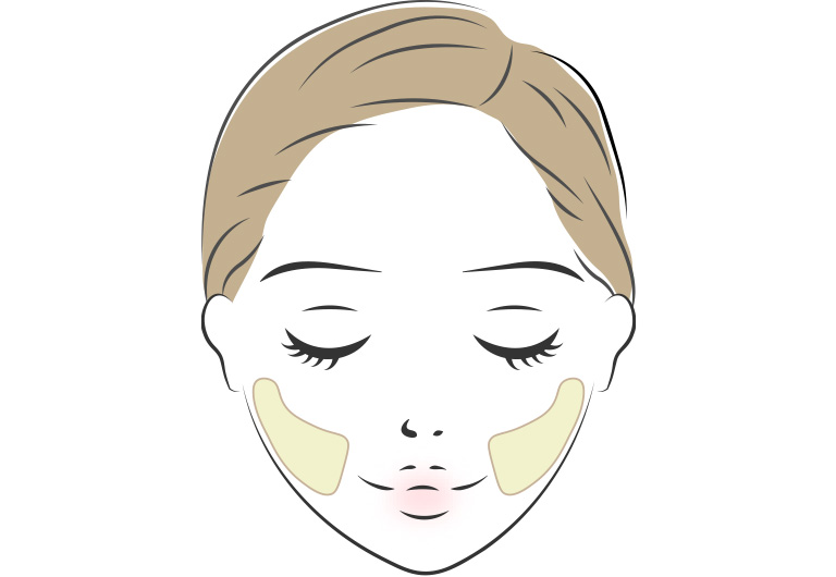 バッカルファット除去