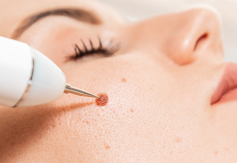 ほくろ・いぼ取りとは