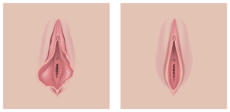 小陰唇縮小術