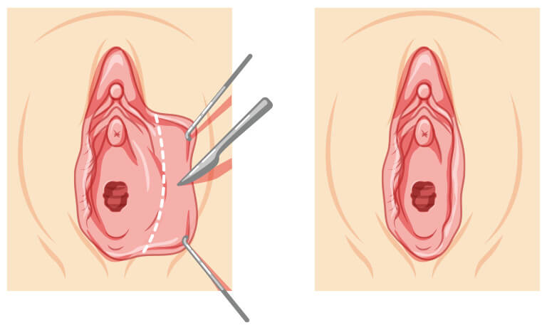 大陰唇たるみ取り（大陰唇縮小術）