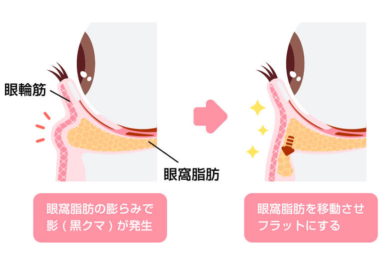 脂肪の移動と骨膜への固定