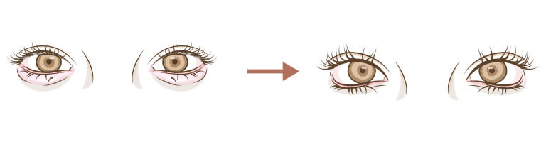 グラマラスライン形成のデザイン