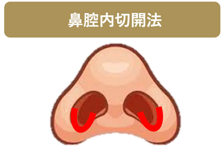 鼻腔内切開法