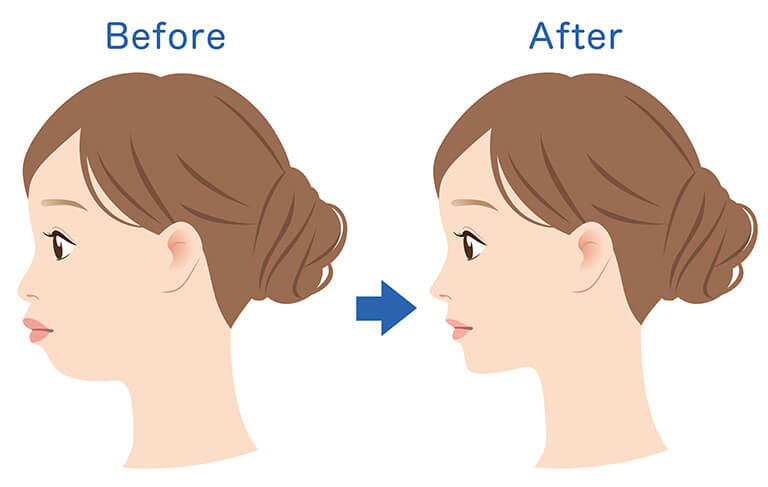 鼻唇角形成術(猫手術)before after