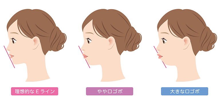 鼻唇角形成術(猫手術)がおすすめな方