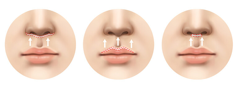 人中短縮術とは