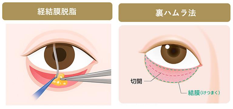 裏ハムラ法と経結膜脱脂術の比較