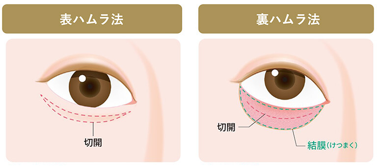 裏ハムラ法と表ハムラ法の比較