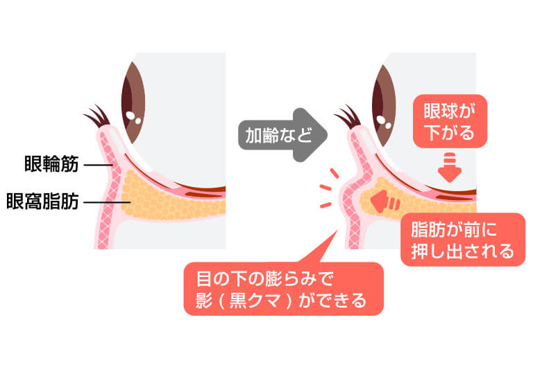 目の下のクマ・たるみが生じる仕組み