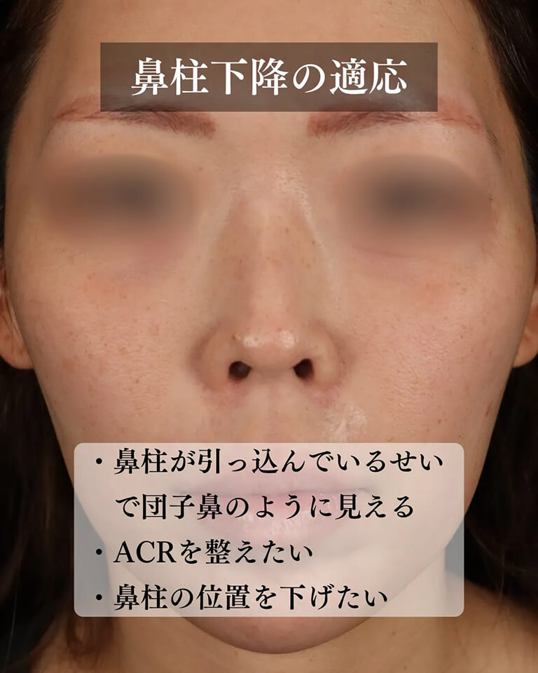 鼻柱下降がおすすめな方
