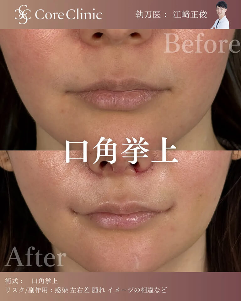 口角挙上・症例