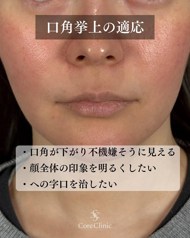 口角挙上術がおすすめの人