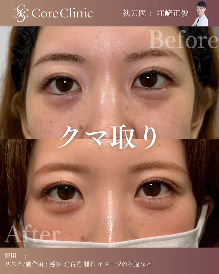 クマ取り・目の下のたるみ取りとは