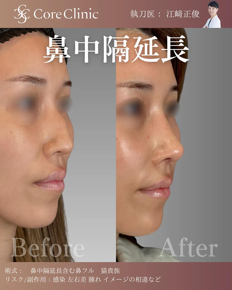コアクリニック江﨑先生医師による鼻中隔延長の症例写真。
