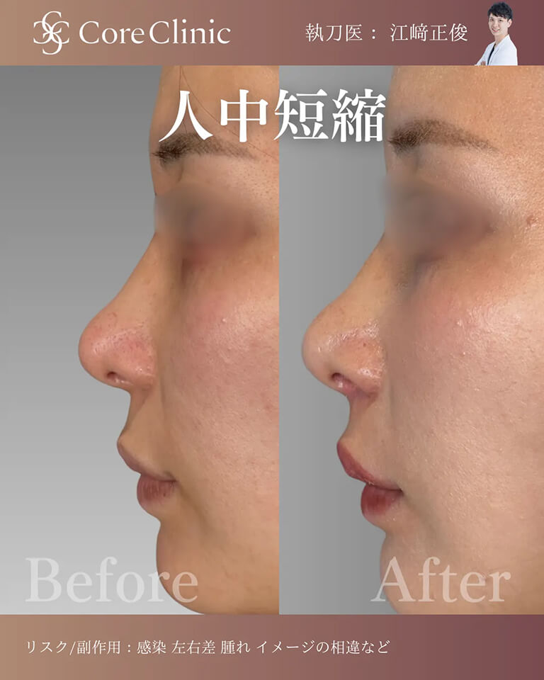 名古屋の人中短縮の症例：横顔の術前後（Before/After）比較｜コアクリニック