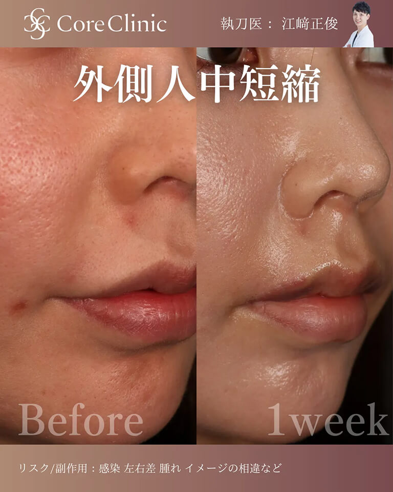 外側人中短縮・症例