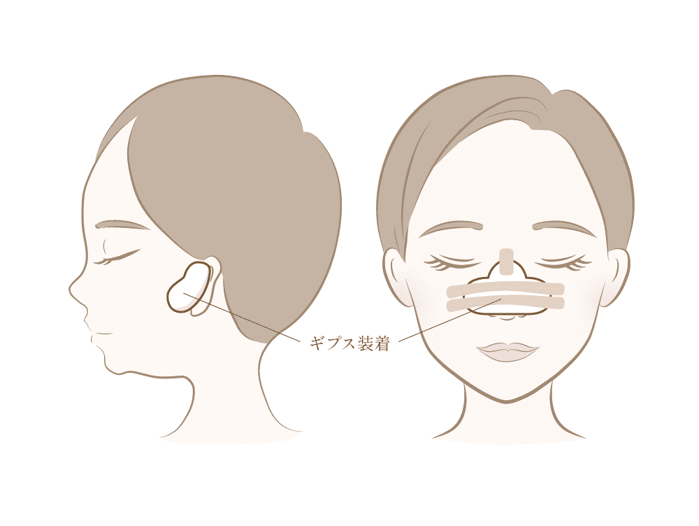 耳介軟骨移植術後にギプスを装着し固定する図解イラスト