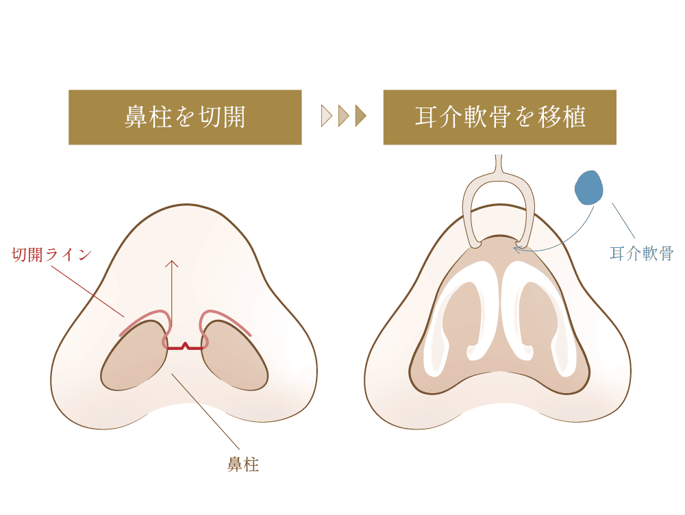 鼻柱を切開し、耳介軟骨移植を行う図解イラスト