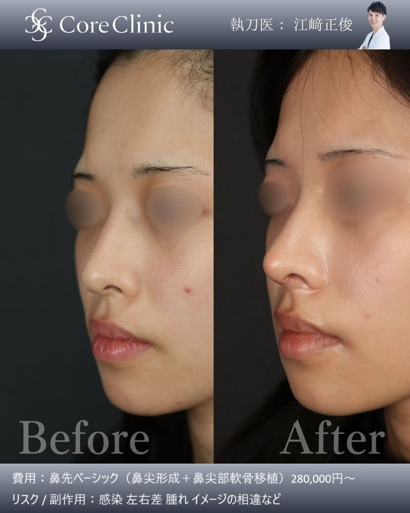 名古屋の鼻尖形成の症例：横の術前後（Before/After）比較｜コアクリニック