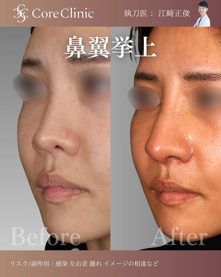 鼻翼挙上の症例:横顔の術前後(Before/After)比較