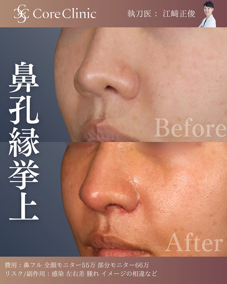 鼻孔縁挙上の症例：横の術前後（Before/After）比較