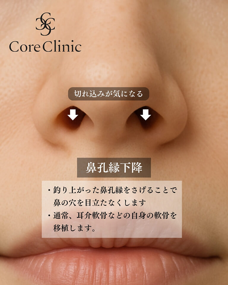 鼻孔縁下降