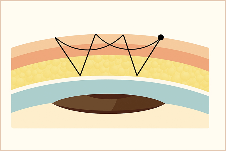 Core Natural(表線留め4点法）