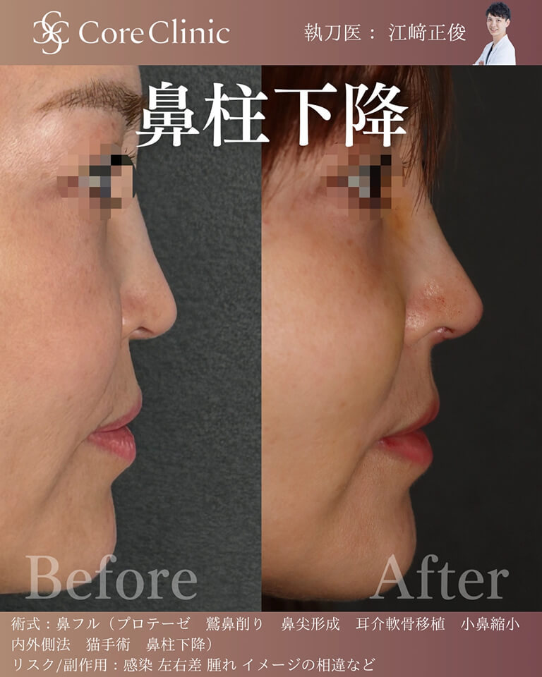 鼻柱下降の症例：横顔の術前後（Before/After）比較