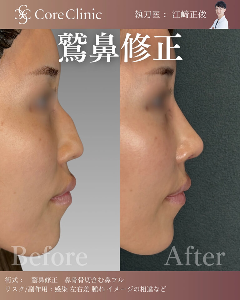 鷲鼻修正の症例:横顔の術前後(Before/After)比較