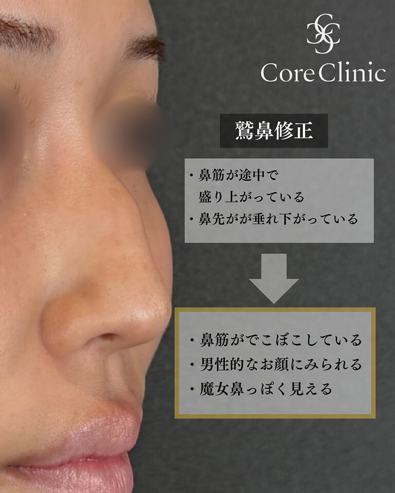 鷲鼻修正がおすすめな方