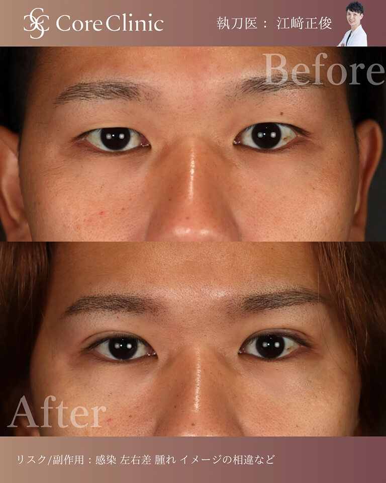 二重全切開の症例（まぶたが厚い方や、たるみがある方）：正面の術前後（Before/After）比較