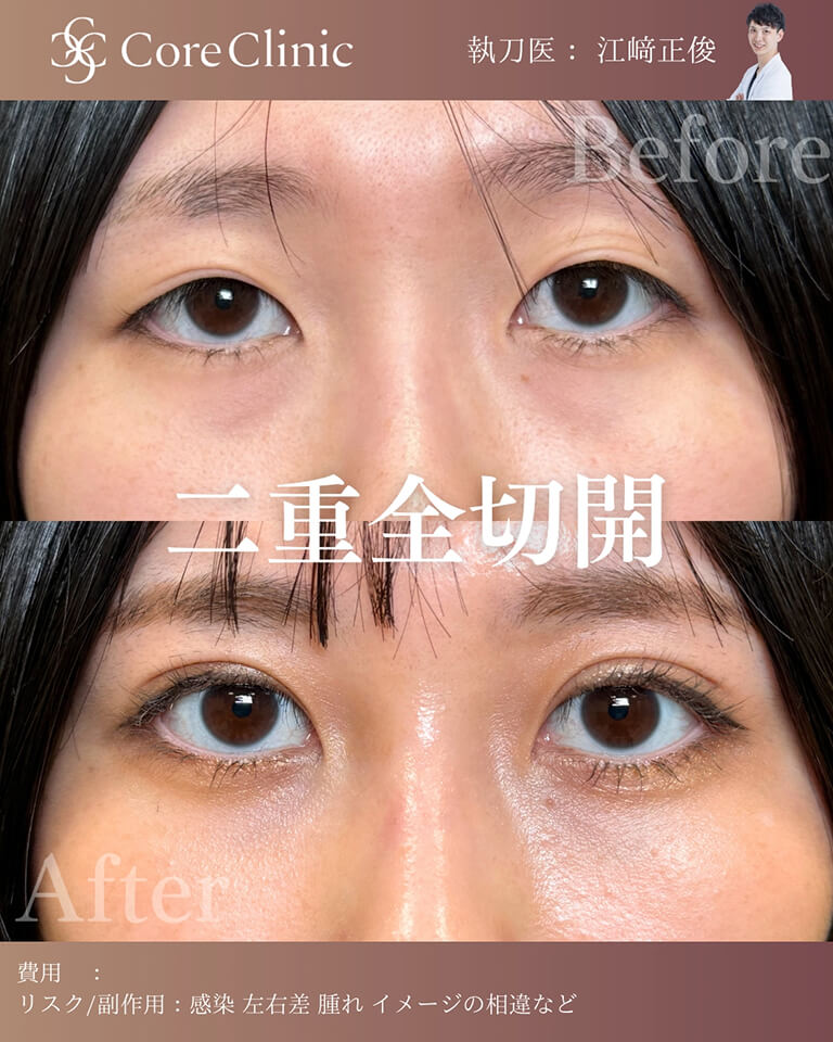 二重全切開の症例：正面の術前後（Before/After）比較