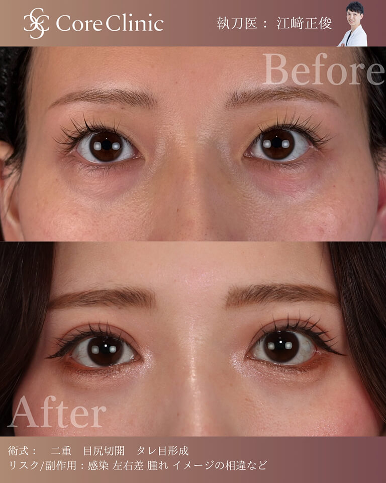 二重全切開の症例（目尻切開・タレ目形成）：正面の術前後（Before/After）比較