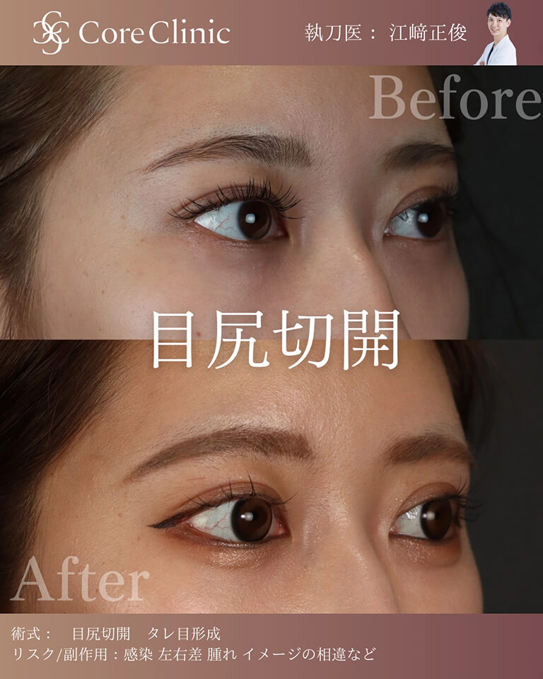 目尻切開の症例:横顔の術前後(Before/After)比較