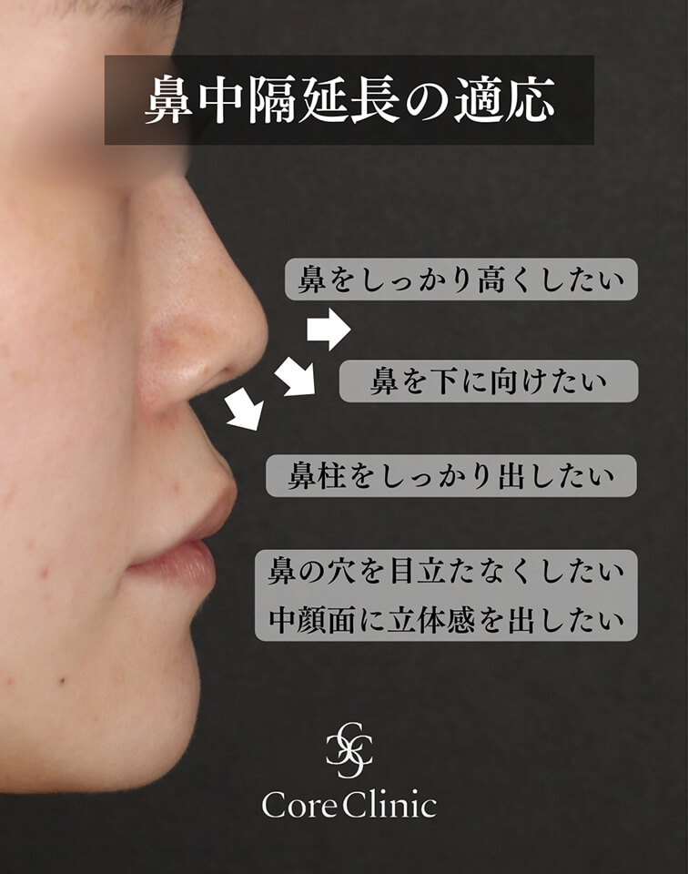 鼻中隔延長がおすすめの方