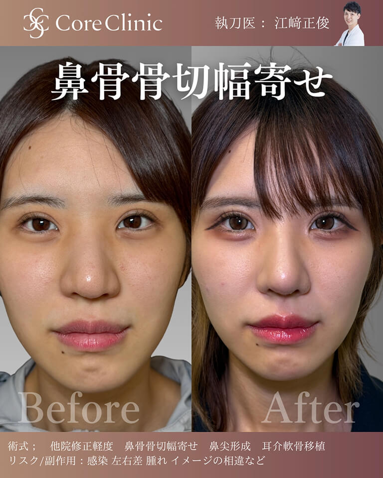 鼻骨骨切り幅寄せの症例：正面の術前後（Before/After）比較