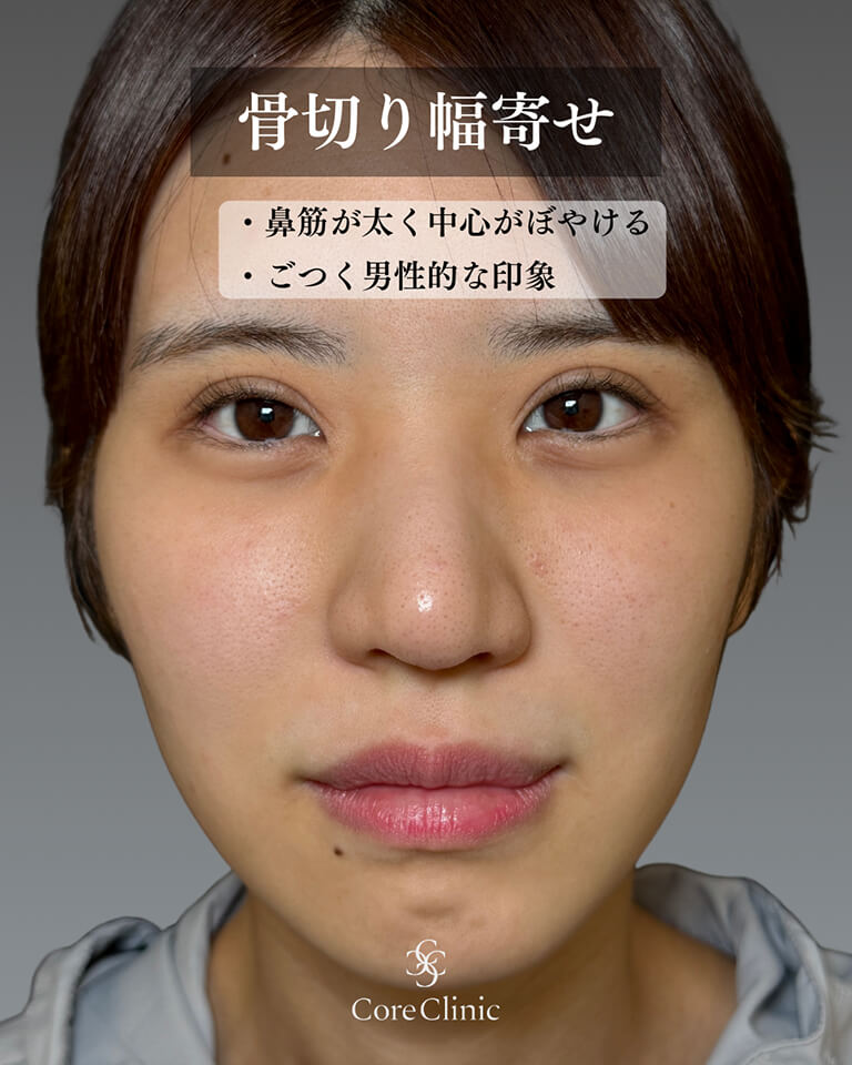 骨切り幅寄せがおすすめな人