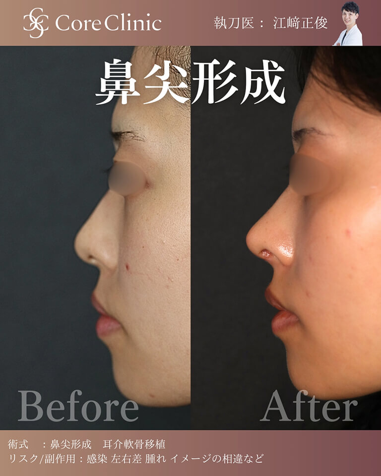 鼻尖形成の症例：横の術前後（Before/After）比較