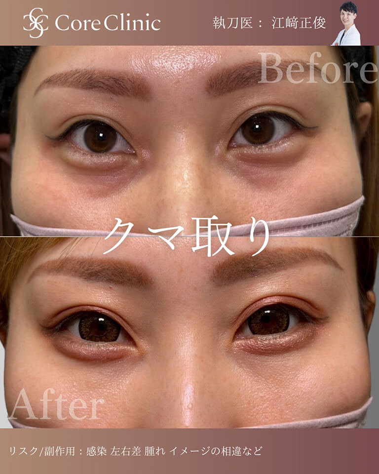 クマ取りの症例：正面の術前後（Before/After）比較