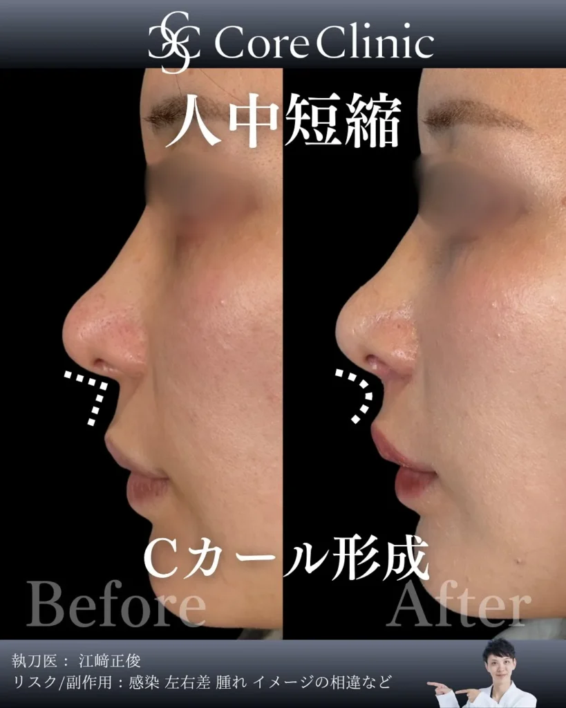 鼻唇角形成（猫手術、Cカール形成）｜Core Clinic（コアクリニック