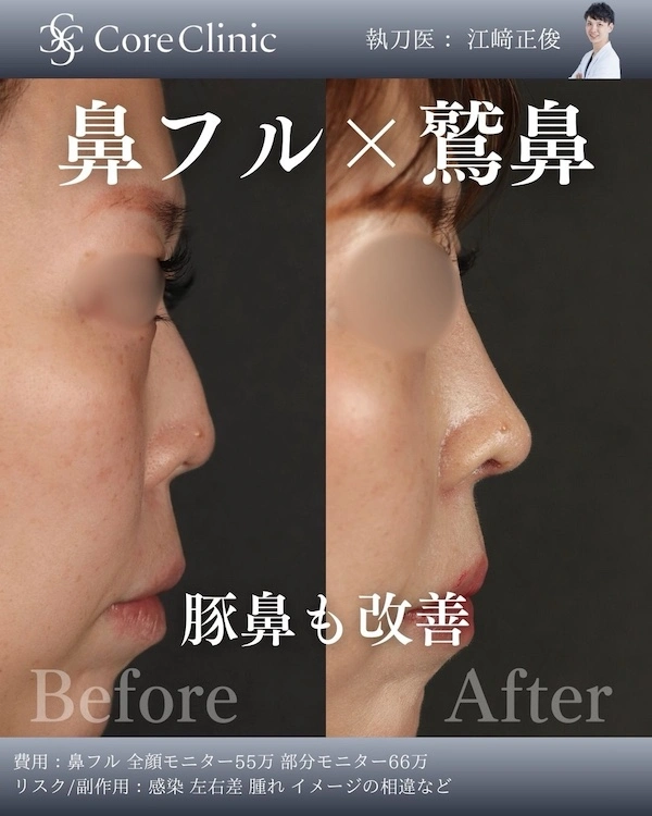 鼻プロテーゼを利用した鼻フル×鷲鼻修正の症例写真