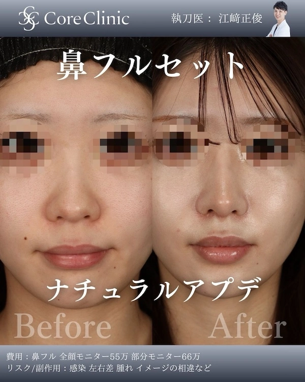 鼻プロテーゼとはなにか具体的に説明している症例写真