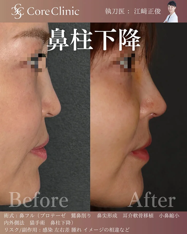 鼻柱下降術の症例①
