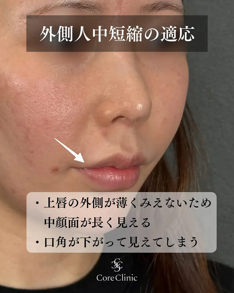 外側人中短縮・上口唇挙上術の症例②
