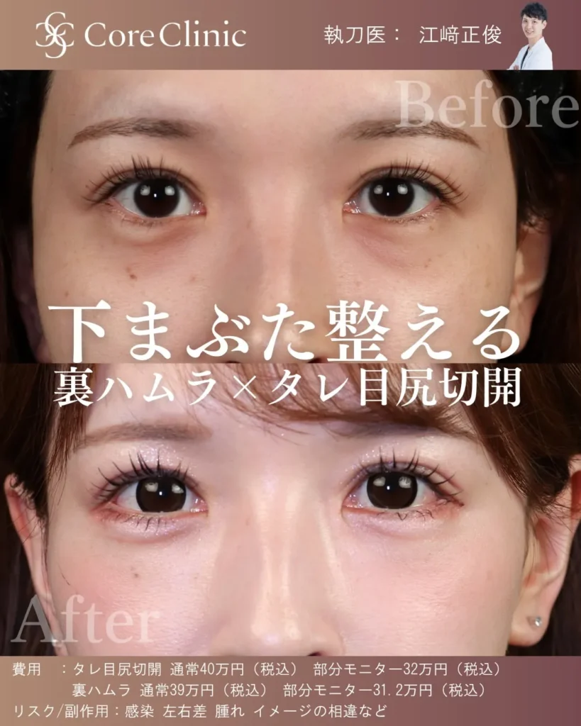 タレ目尻切開(目尻靱帯移動)の1か月の正面から見た症例
