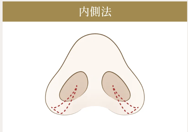 小鼻縮小(鼻翼縮小)の施術方法①